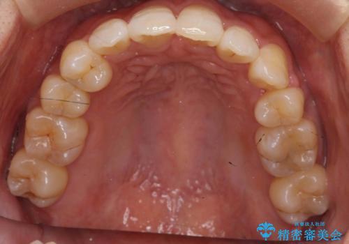 40代女性　前歯の重なり　あきらめずに矯正の治療後