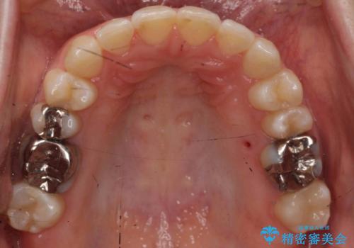 抜かない、削らない矯正 大人も上顎を骨から広げますの治療後