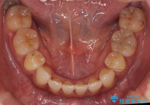 40代女性 前歯の重なり あきらめずに矯正の治療後