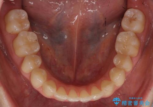 抜かない、削らない矯正 大人も上顎を骨から広げますの治療後