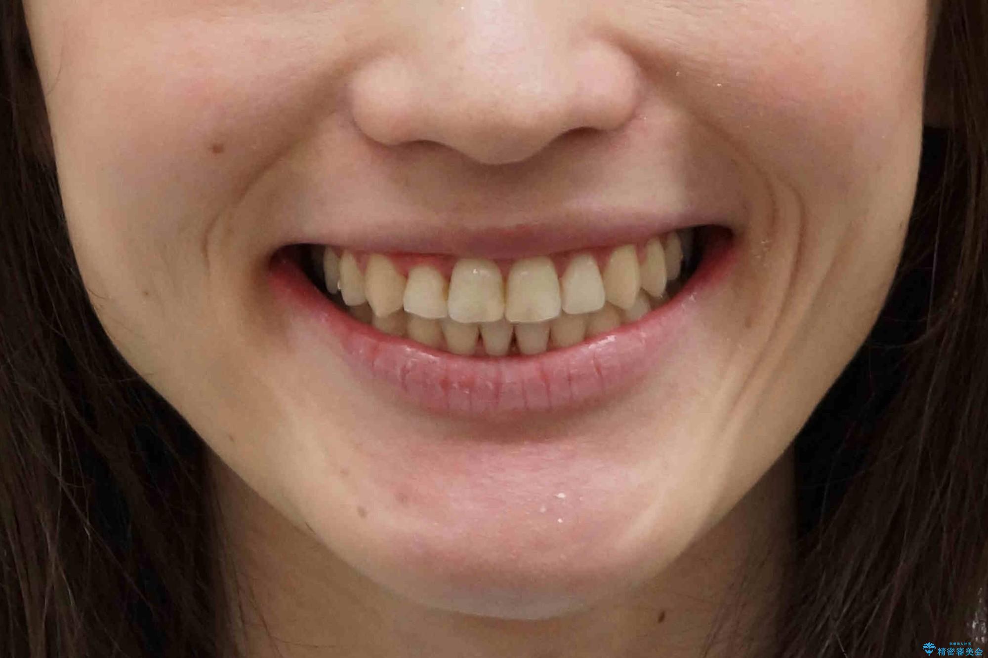 抜かない、削らない矯正 大人も上顎を骨から広げますの治療後(顔貌)