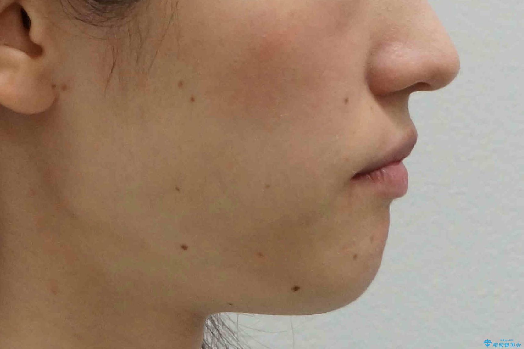 抜かない、削らない矯正 大人も上顎を骨から広げますの治療後(顔貌)