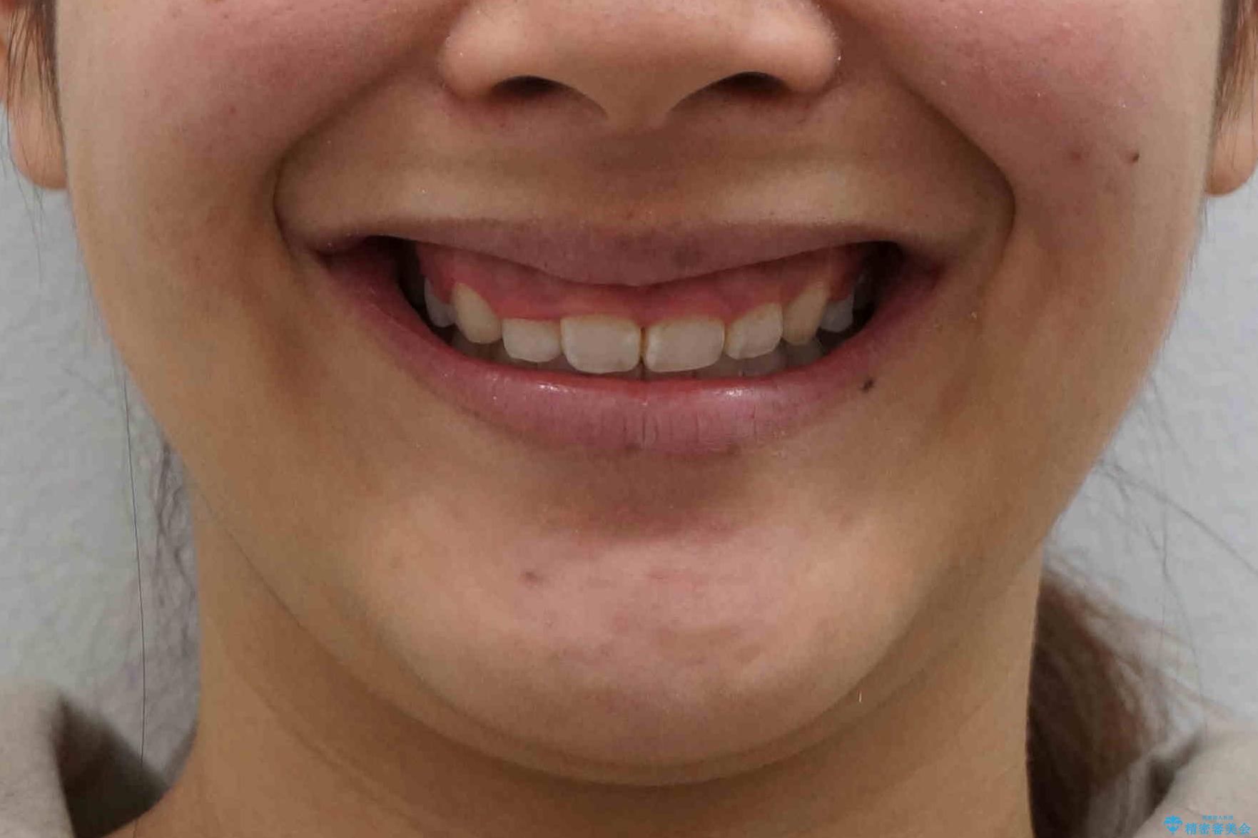 前歯のがたがた　前歯が内側に傾いているの治療後（顔貌）