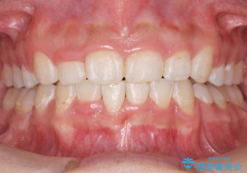 前歯のがたがた　前歯が内側に傾いているの症例 治療後