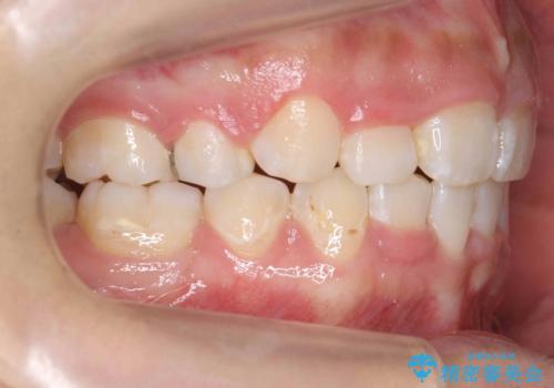 前歯のがたがた　前歯が内側に傾いているの治療後