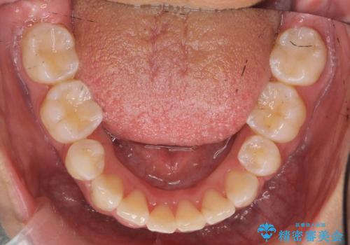 前歯のがたがた　前歯が内側に傾いているの治療後