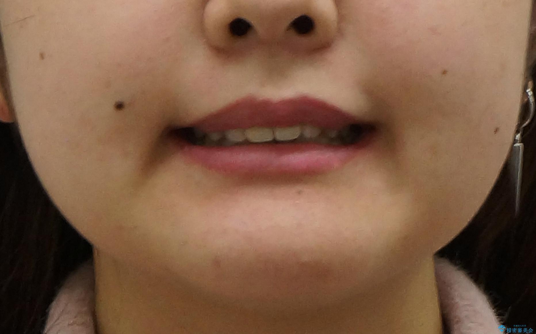 出っ歯をセラミックで治したい の治療後(顔貌)