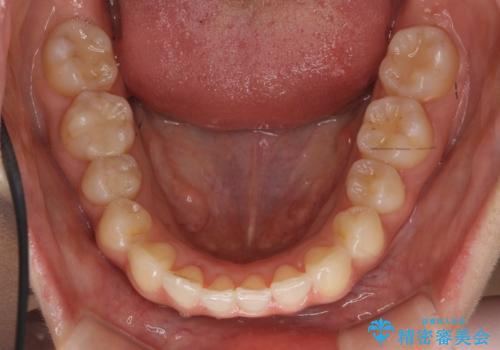 犬歯のねじれ　下の歯のがたがた　インビザラインでの治療後