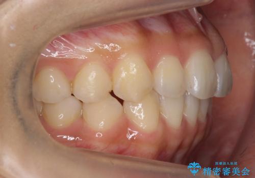 犬歯のねじれ　下の歯のがたがた　インビザラインでの治療後