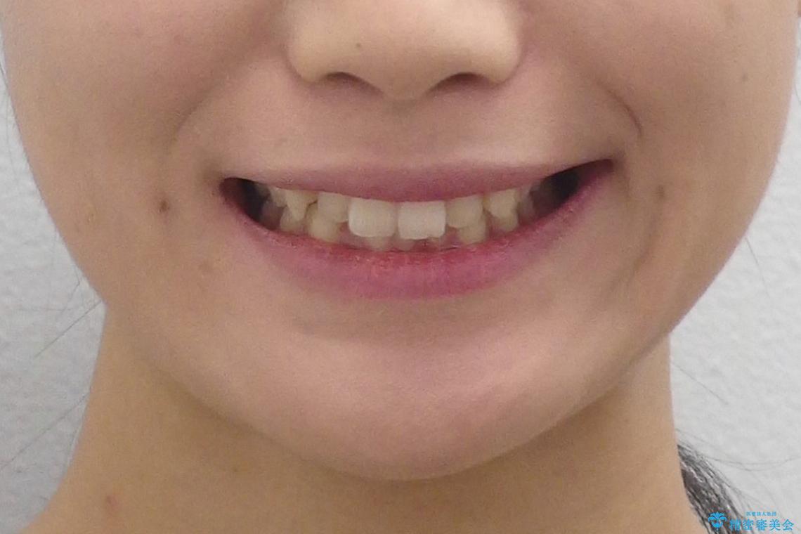 犬歯のねじれ　下の歯のがたがた　インビザラインでの治療前（顔貌）