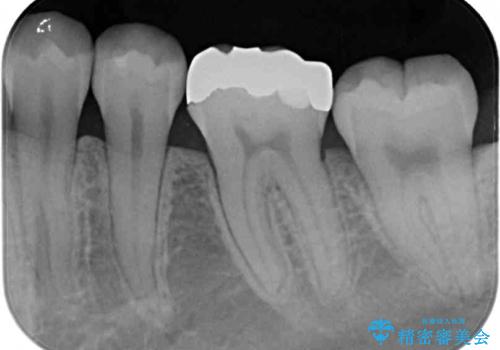 目立つ奥歯の銀歯をセラミックインレーにの治療前