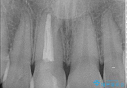 前歯をきれいにしたい ジルコニアクラウンによる審美治療の治療前