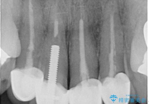 歯茎の黒ずみがきになる 前歯の見た目を改善したいの治療前