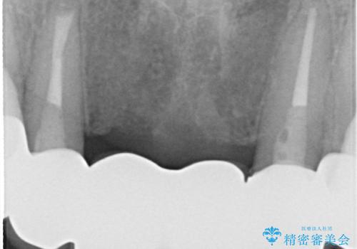 前歯のブリッジの見栄えが悪い→見えないところからしっかりとやり直しをの治療後