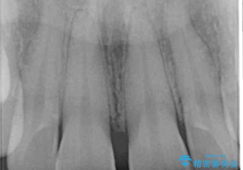 前歯の隙間をオールセラミックで閉じるの治療前