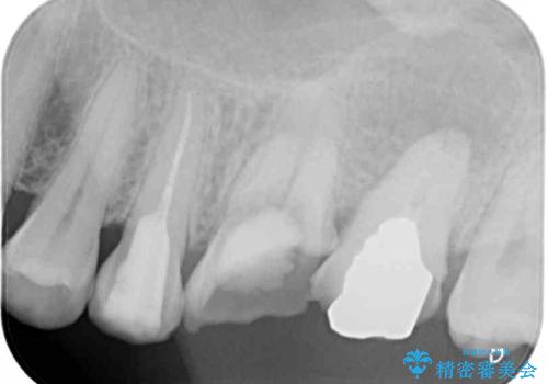 長い間虫歯を放置　奥歯のブリッジ治療の治療前