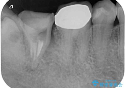 部分矯正を併用した、ストローマンインプラントによる奥歯の咬合回復の治療前
