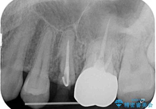 異臭のする歯を抜歯 奥歯のセラミックブリッジ治療の治療前