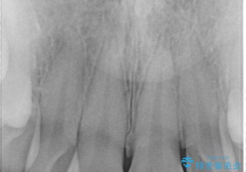 出っ歯をセラミックで治したい の治療前