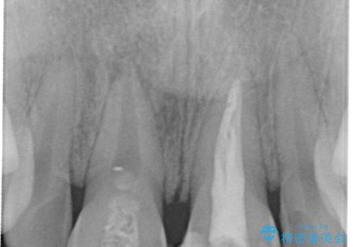 短期集中  前歯審美治療の治療前