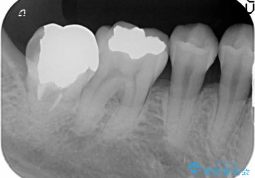 一番奥歯の後ろに虫歯が　処置の難しい虫歯の治療前