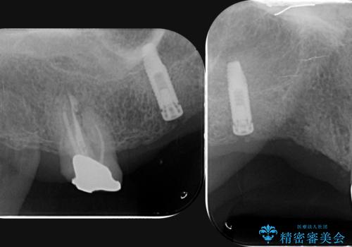他院で中途半端に終わってしまったインプラント治療 の治療前