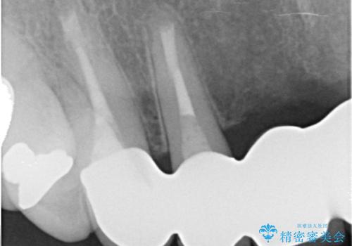 前歯のブリッジの見栄えが悪い→見えないところからしっかりとやり直しをの治療後