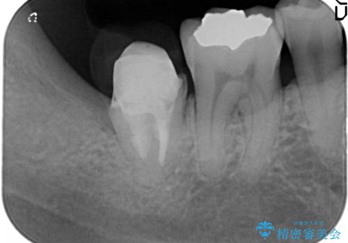 一番奥歯の後ろに虫歯が　処置の難しい虫歯の治療中