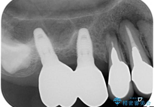 薄い骨にもインプラントを スプリットクレスト+ショートインプラントの応用の治療前