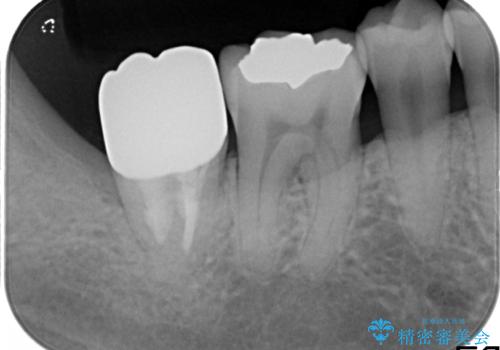 一番奥歯の後ろに虫歯が　処置の難しい虫歯の治療後