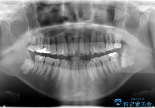 インビザライン invisalign ガタつきを治すマウスピース矯正の治療前