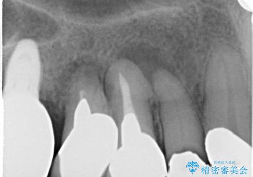 前歯の低クオリティな治療の実態 妥協無い治療で根本からやり治すの治療前