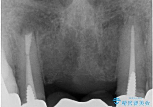 前歯のブリッジの見栄えが悪い→見えないところからしっかりとやり直しをの治療前