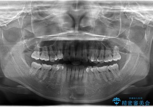 抜歯せずに八重歯のマウスピース矯正の治療前