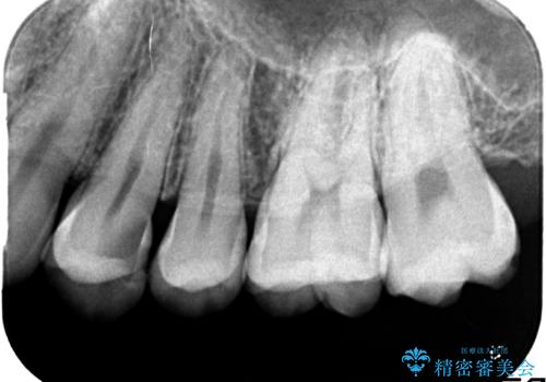 気づかないうちに大きな虫歯が　神経を保存し、セラミックで修復の治療前