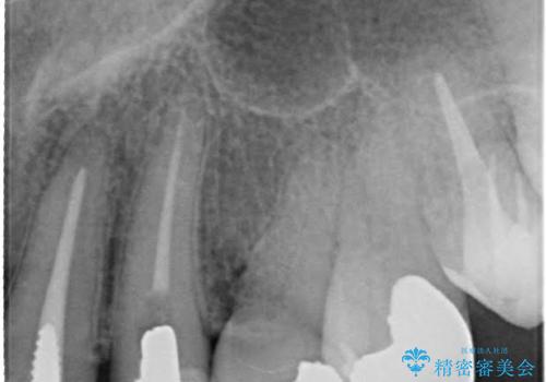 前歯のブリッジの見栄えが悪い→見えないところからしっかりとやり直しをの治療前