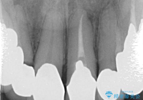 前歯の低クオリティな治療の実態 妥協無い治療で根本からやり治すの治療前