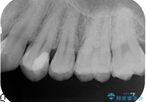 気づかないうちに大きな虫歯が 神経を保存し、セラミックで修復の治療後