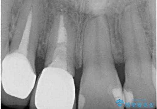 前歯がぐらぐらする 抜歯→ブリッジへ の治療前