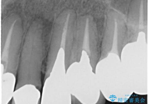 前歯の低クオリティな治療の実態 妥協無い治療で根本からやり治すの治療前