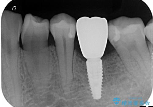 深い虫歯により抜歯となった奥歯　インプラント治療でかみ合わせを回復するの症例 治療後