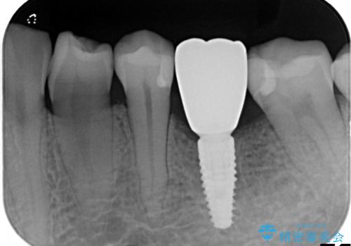 深い虫歯により抜歯となった奥歯　インプラント治療でかみ合わせを回復するの治療後
