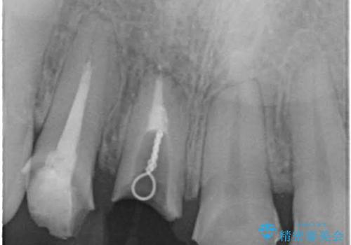 前歯がぐらぐらする 抜歯→ブリッジへ の治療中