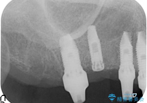 他院で中途半端に終わってしまったインプラント治療 の治療後