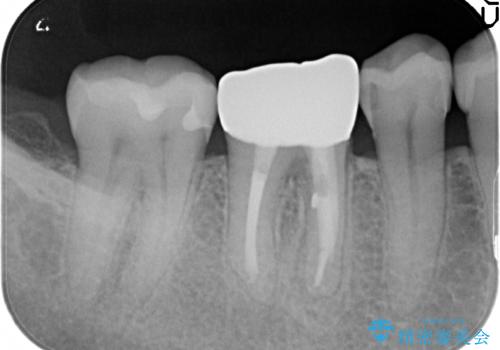 咬んだ時の違和感　顕微鏡で発見された歯の穴を処置し、かみ合わせを回復するの治療後