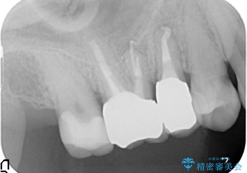 歯周外科・根管治療による長期予後を期待する奥歯の治療の治療後
