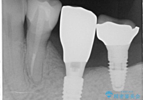 奥歯がない　インプラント治療でかみあわせを回復の治療後