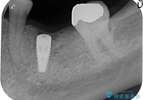 見えない歯周病　長期予後を見据えてインプラントにの治療中