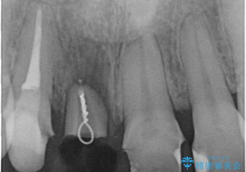 前歯がぐらぐらする 抜歯→ブリッジへ の治療中