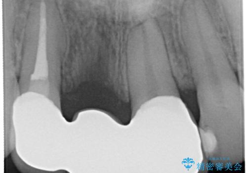 前歯がぐらぐらする　抜歯→ブリッジへ　の治療後